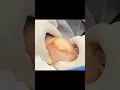 Lagu Check Out This Blob Lipoma on the Arm!