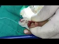 Download Lagu Wart (part 1)  -  Siğil bölüm 1  https://youtu.be/CasZaDNI3XU