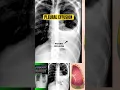 Chest X-Ray Findings in Pneumonia with Pleural Effusion