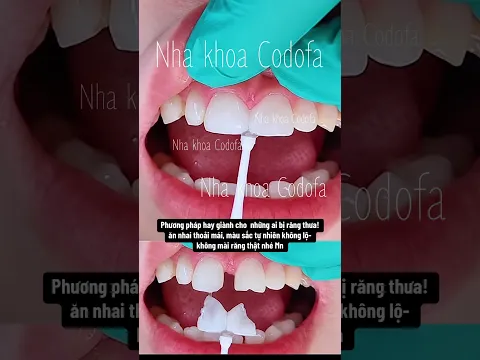 Đóng khe thưa - không mài răng #nhakhoacodofa #dentist #răngsứthẩmmỹ #veneers