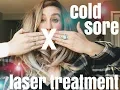 LASER for COLD SORES