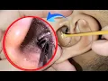 Download Lagu Most Disgusting Ear Cleaning Ever! 🤢 | Extreme Earwax Removal ASMR | EP 157