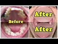 Download Before & After Braces -Time Lapse - 2 Years & 18 Days - +Mewing mp4 3gp mp3 videos - waplic