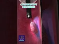 How to Performed Colonoscopy Endoscopy Procedure