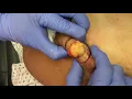 Download Lagu Lipoma Removal on Shoulder