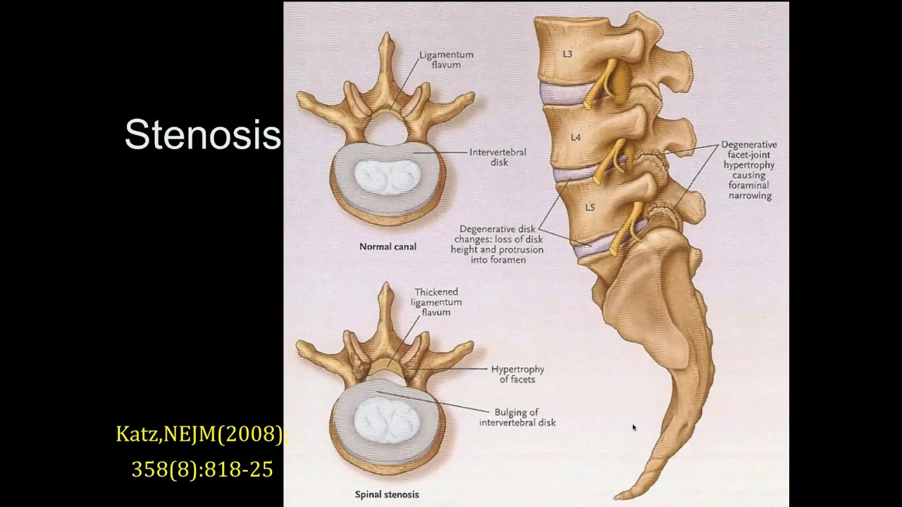 Hernia Nukleus Pulposus. 