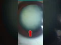 Download Lagu What Does a Cataract Look Like Inside Your Eye? (Visual Representation)