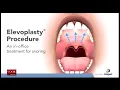 Elevoplasty Snoring Treatment