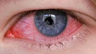 علاج إلتهاب العين طبيعيا والتخلص من إحمرار العين في المنزل بدقائق دندنها