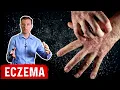 Use ACV Apple Cider Vinegar for Eczema