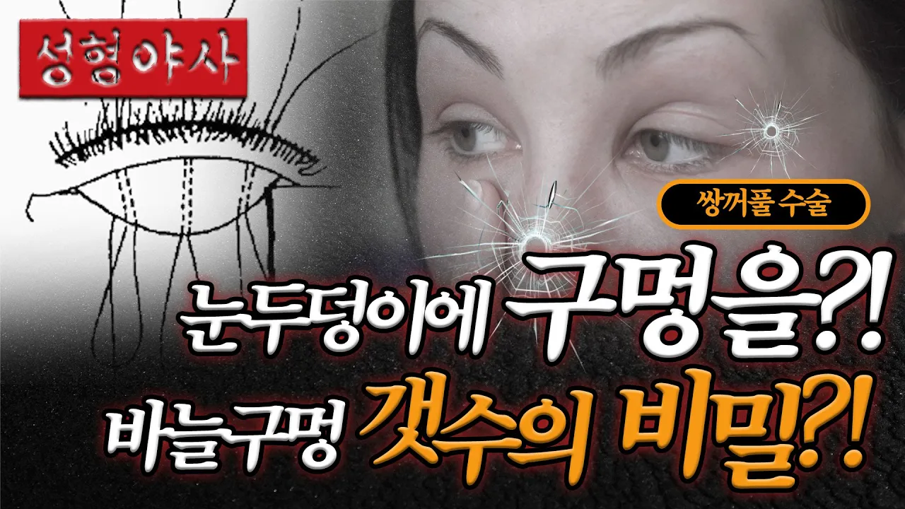매몰 쌍꺼풀 수술 할 때 구멍 7개만 뚫으세요. 비절개 쌍수 흉터 안 보이는 이유 | 성형야사
