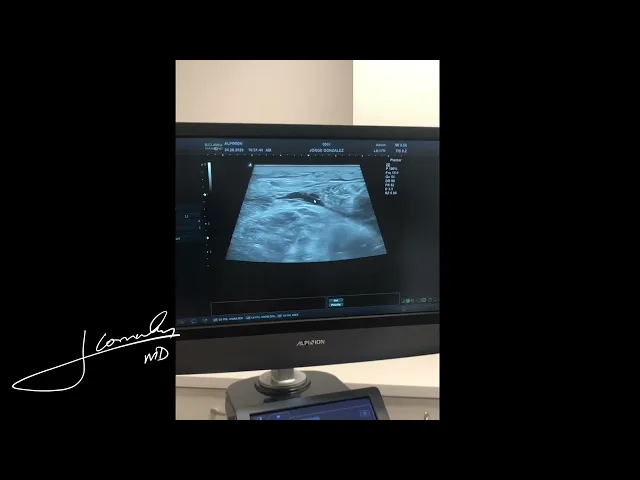 What Is Tennis Leg? Calf Muscle Tear Explained | Fort Lauderdale