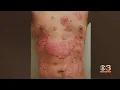 New research from UPenn says drug used to treat skin condition can also help people lose weight