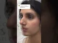 Transform your nose in minutes with NO surgery