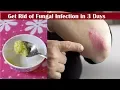 Use Garlic This Way to Get Rid of Fungal Infections in 3 Days Home Remedy
