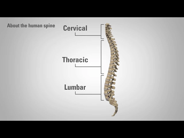 Radiculopathy - Patient Education