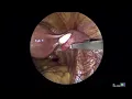 25 103 Diagnostic Laparoscopy for the Diagnosis of Endometriosis