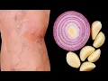 Download Lagu 2 Natuurlijke fixes die mijn spataderen hebben gewist! Je zult het niet geloven!