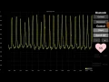 ECG android-arduino project for Biomedical Technology AUTH