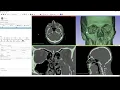 Part 1 - Using 3D Slicer to create a human skull and orbit model from a CT scan