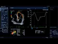 Download Lagu Automatisches 2D Wallmotion Tracking - Canon Medical Systems