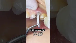 انقاذ ضرس وتلبيسات طبيعي ة قوي ة 