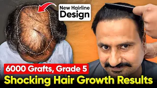 How I Changed My Life Completely, Norwood 6 Hair Transplant