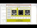 Matlab Project Image Fusion on MRI And CT Image Using Wavelet Transform