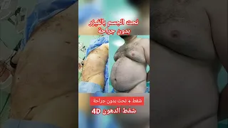 مراحل شفط الدهون بالفيزر بدون جراحة نحت البطن نحت الخصر نحت جسم شاهد بالفيديو كمية الدهون 