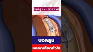 ทำไมถึงต้องทำไบพาแทนการทำบอลูนบ้าง