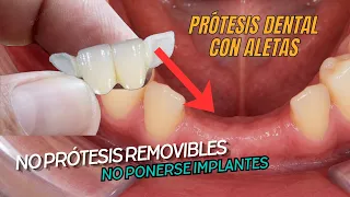 Prótesis dental maryland, diente con aletas