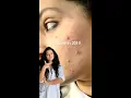 This Product Fixed My Acne and Blackheads Paulas Choice BHA