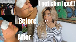 I GOT CHIN LIPO DOWN IN MEXICO HOW MUCH I PAID WAS IT WORTH IT LET ME TELL YOU THE TEA