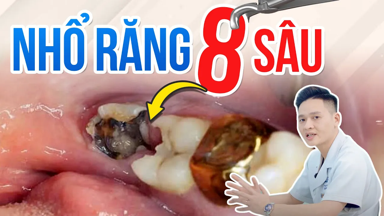 Outline Video Nhổ Răng Khôn Sâu: Nên Hay Không? 1 Phút Đầu Video Có Ngay Câu Trả Lời! Lạc Việt Intech