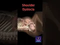 Download Lagu Baby Stuck During Birth | Shoulder Dystocia #shorts #pregnancy #youtubeshorts