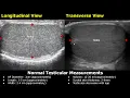 How To Measure Scrotum On Ultrasound Testis Epididymis AP Diameter Length Width Volume USG