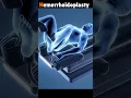Download Lagu 3D Animation of Hemorrhoidoplasty Procedure. #shorts