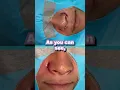 Download Lagu Kan een diagonale neusvorm worden gecorrigeerd? | ALARPLASTY voor en na