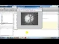 glaucoma detection using MATLAB