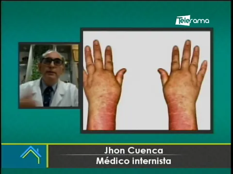 ¿Por qué el Rey Carlos III presenta hinchazón y enrojecimiento en las manos?