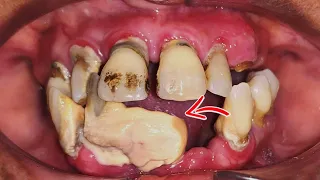 Front Teeth Tartar Removal on a Female Patient.