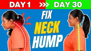 Fix Neck Hump in 30 Days 🔥 | 6 Daily Exercises for Better Posture I Neck Pain Relief Hindi