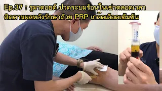  วิธีการรักษาด้วยเกล็ดเลือดเข้มข้นช่วยลดอาการเจ็บหัวเข่าได้อย่างไร 