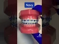 Braces colors that make your teeth look white