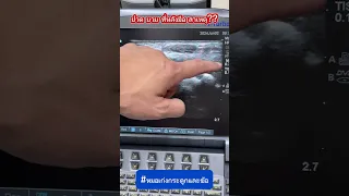 ก้อนที่เกิดขึ้นที่ข้อมือมีสาเหตุมาจากอะไร และเป็นลักษณะของเนื้อเยื่อใด