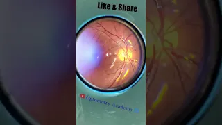 Smartphone Fundus Videography Fundus Photography Short Video 21 