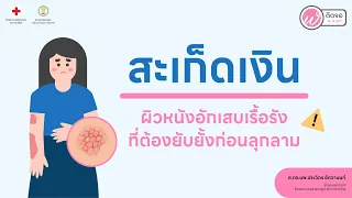 สะเก็ดเงินเกิดจากอะไรบ้าง
