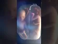 Download Lagu Twins Fighting in Mother's Womb #shorts