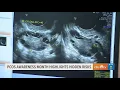 Polycystic Ovary Syndrome Awareness Month highlights hidden risks