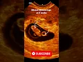 Missed Miscarriage at 8 Weeks Ultrasound Scan